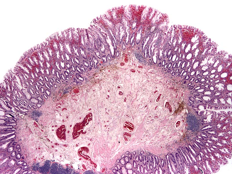 tubulovillous polyp