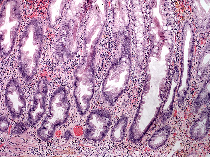 pathology-outlines-sessile-serrated-adenoma