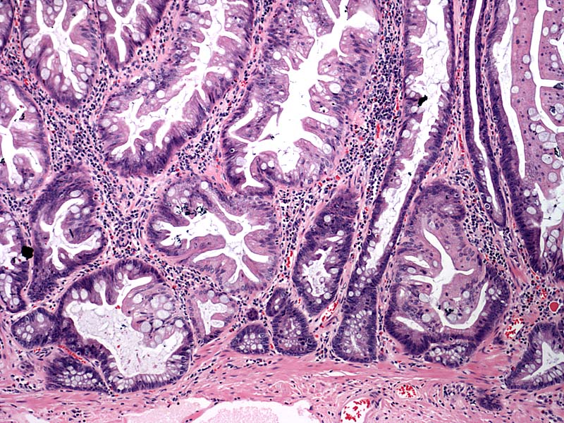 ascending colon polypectomy tubular adenoma
