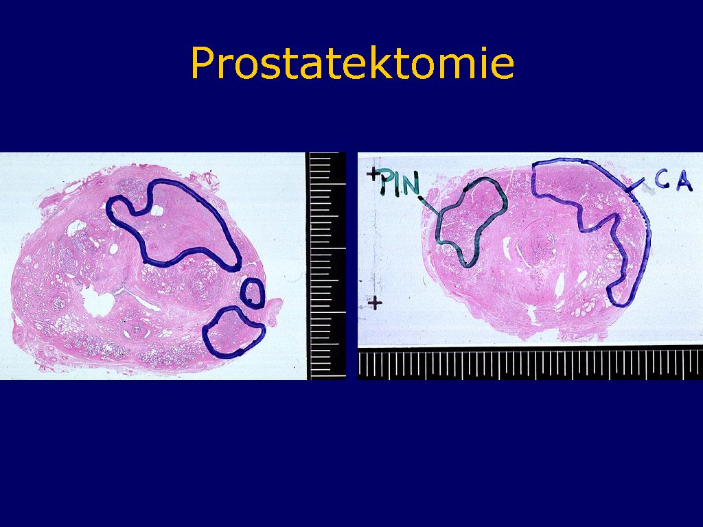 Prostatektomie