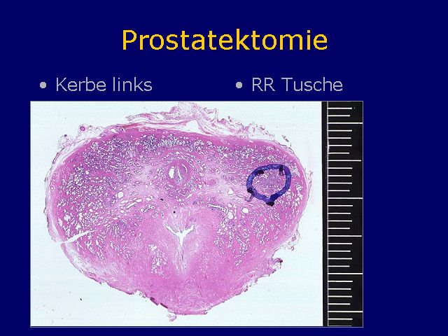 Prostatektomie