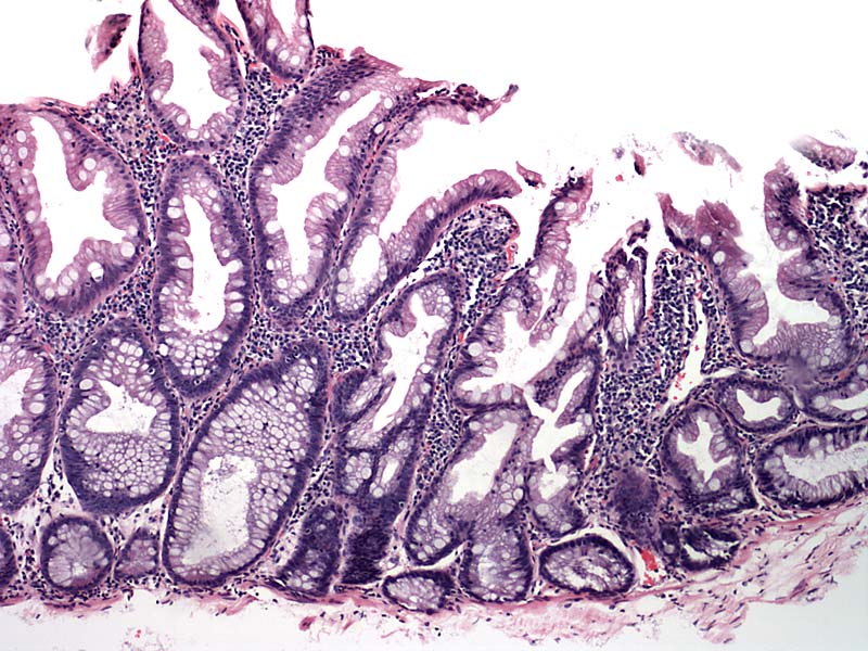 Pathology Outlines - Sessile serrated adenoma